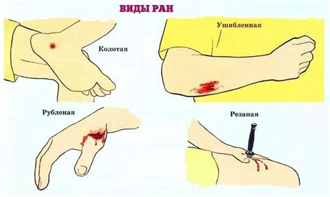 Избегайте трения и движения раны