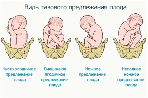 Изменение положения плода