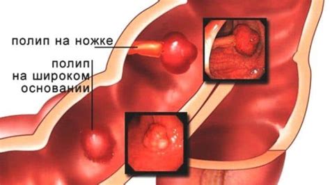 Индикации для удаления полипов в прямой кишке