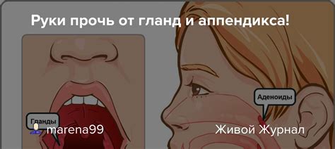 Использование народных методов для очищения гланд от белых пробок