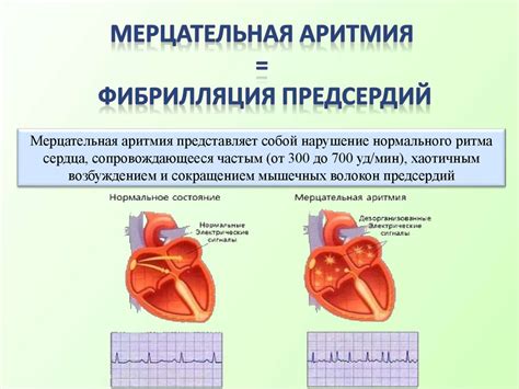 Исследования о влиянии боярышника на мерцательную аритмию