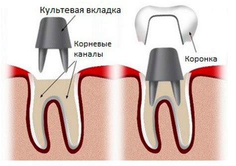 Какая роль играет вкладка при определении стоимости коронки?