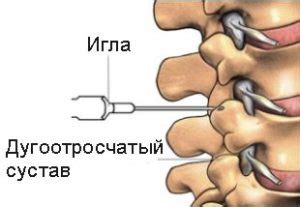 Каковы методы лечения и профилактики блокады позвоночника?