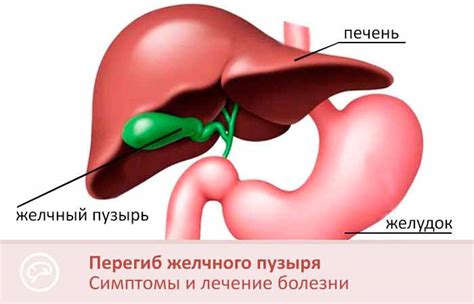 Каковы последствия перегиба желчного пузыря?