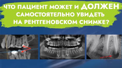 Какое влияние на рентгеновское исследование оказывает прием пищи?