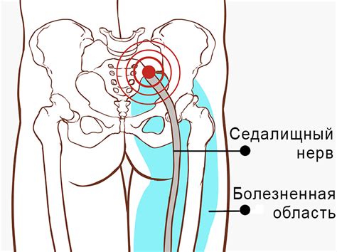 Как воспаление седалищного нерва влияет на возможность ходить