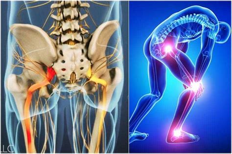 Как воспаление седалищного нерва влияет на облегчение движений