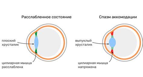 Как диагностировать спазм аккомодации?