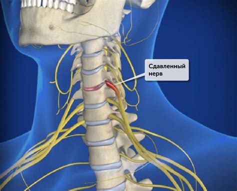 Как застудить нерв на шее