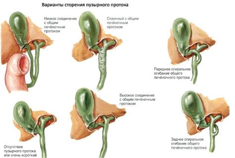 Как лечить загиб желчного пузыря?