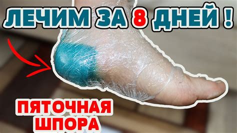 Как можно предотвратить появление шпор на пятках?