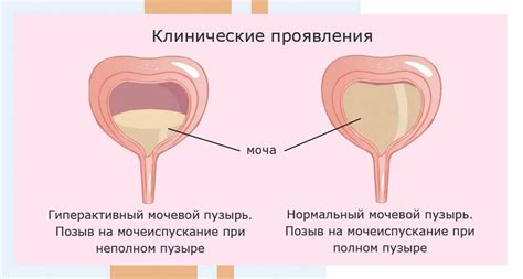 Как определить, нужно ли шить мочевой пузырь самостоятельно