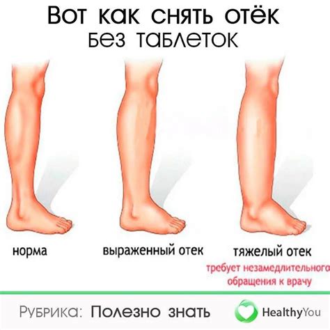 Как определить, что отек ног обусловлен ходьбой