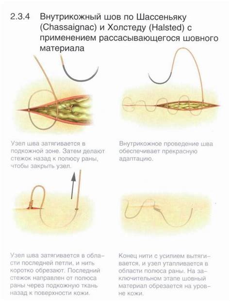 Как определить необходимость снятия швов?