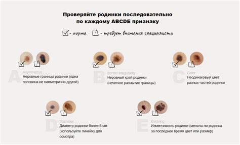 Как определить опасные родинки