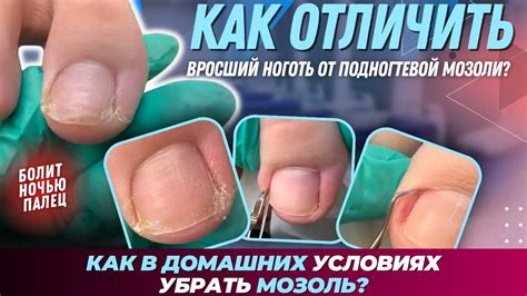 Как отличить чернеющий ноготь от других проблем?
