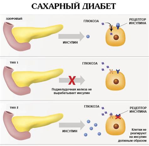 Как передается тип 1 диабета