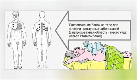 Как правильно ставить банки после пневмонии у взрослых