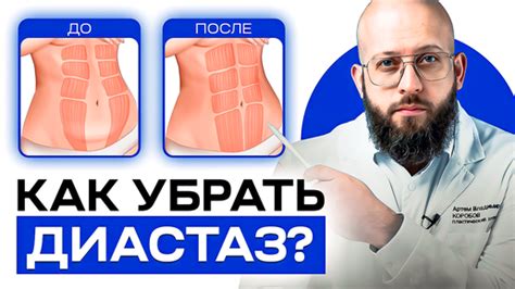 Как предотвратить и лечить диастаз у женщин