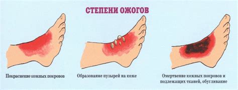 Как происходит ожог и что происходит, когда слезла кожа: появление, признаки, лечение