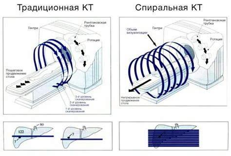 Как работает аппарат Илазарова?