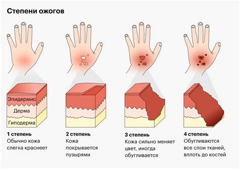 Как распознать степень ожога и какие симптомы возникают, когда слезла кожа?