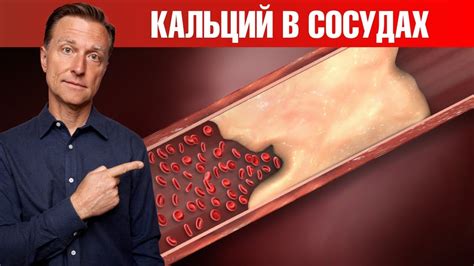 Кальциноз сосудов: причины и симптомы