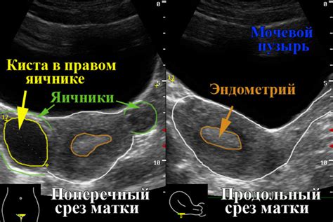 Киста яичника при менопаузе: сохранить или удалить?