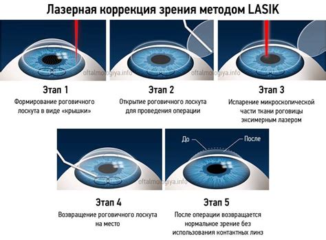 Когда и как можно мыться после коррекции зрения?