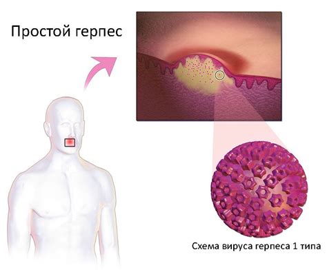 Когда можно целоваться при герпесе и простуде на губах