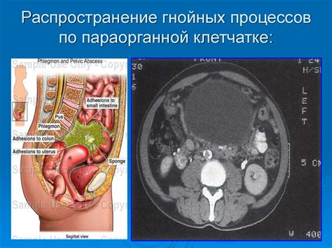 Консервативное лечение гнойных процессов в лимфоузлах