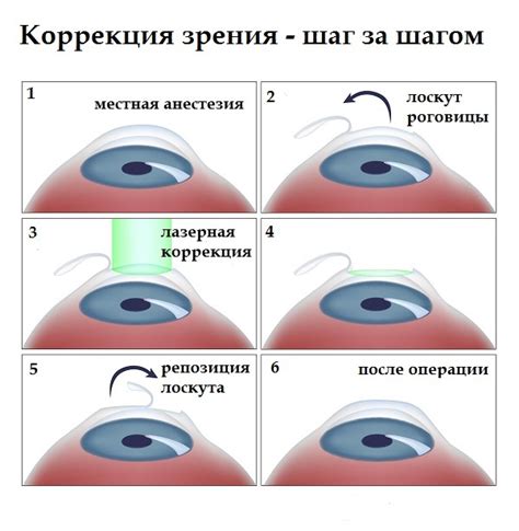 Коррекция зрения при катаракте: современные методы и рекомендации