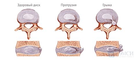 Корсет и грыжа: причины и последствия