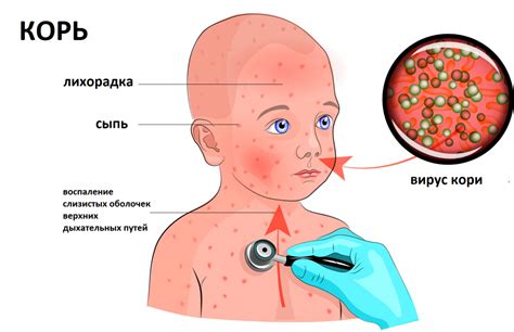 Корья – инфекционное заболевание