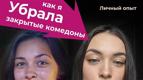 Косметические процедуры для борьбы с закрытыми комедонами на щеках