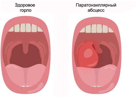 Лечение абсцесса горла: