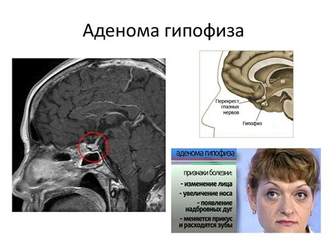 Лечение аденомы и сопутствующих симптомов