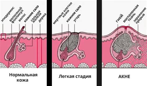 Лечение гормональных сбоев у 13-летних подростков