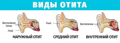 Лечение отита