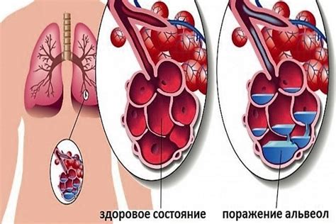 Медицинские банки при воспалении легких: действие и возможность применения