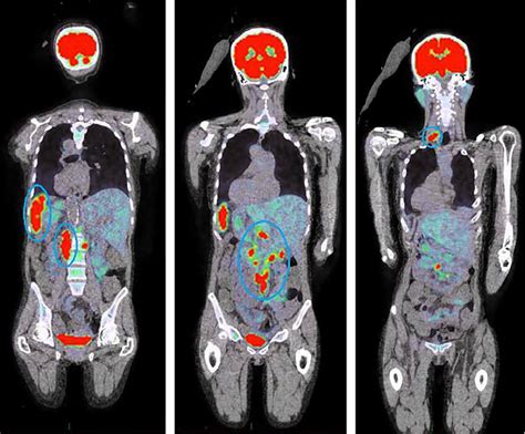 Медицинские цели пэт кт всего тела