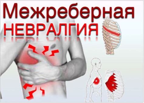 Межреберная невралгия: диагностика и лечение