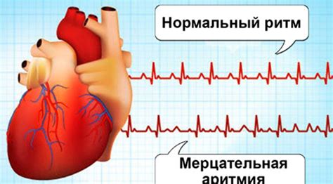 Мерцательная аритмия