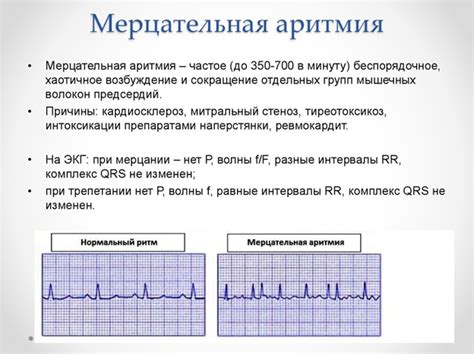 Мерцательная аритмия: можно ли париться