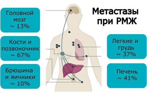 Метастазы при химиотерапии: риск распространения заболевания