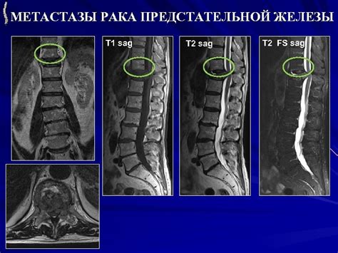 Методы диагностики метастазов при раке простаты