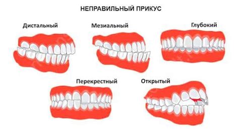 Методы лечения неправильного прикуса