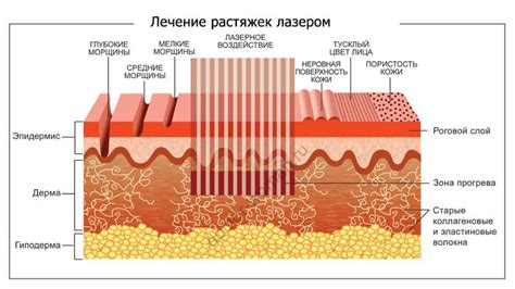 Методы удаления растяжек