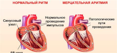 Механизмы возникновения аритмии при нервозности