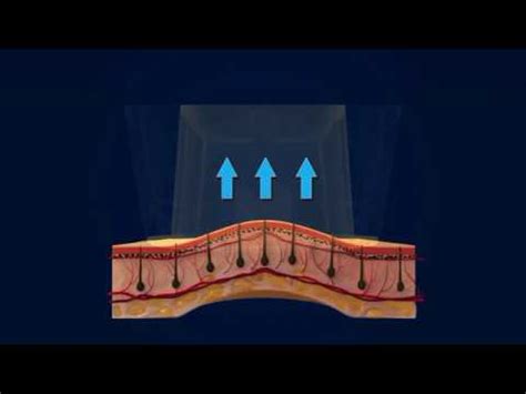 Механизм действия лазерной эпиляции